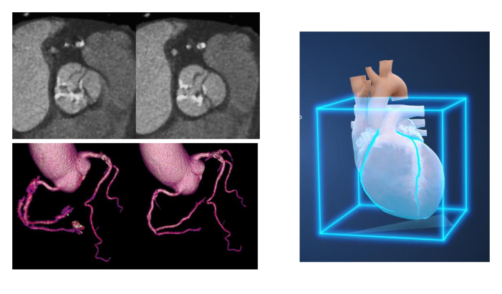 Imagerie cardiaque avec la technologie SnapShot Freeze